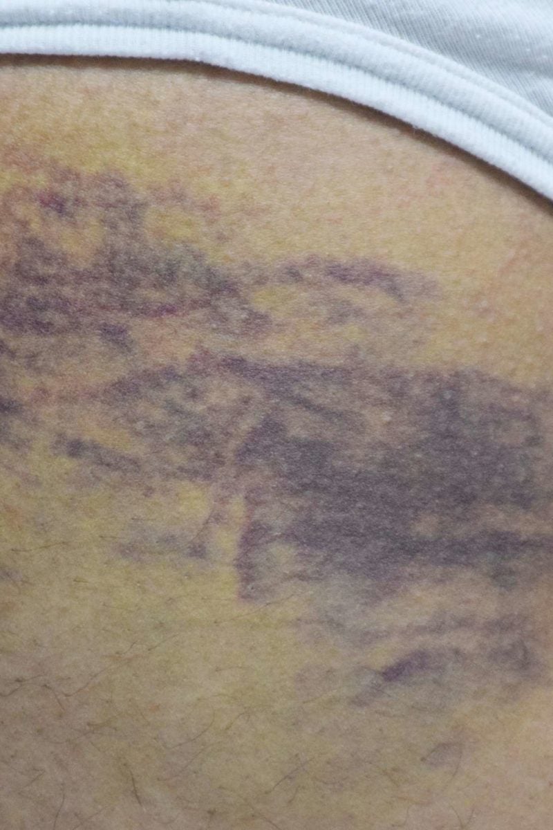 skin dark bruises symptoms treatment