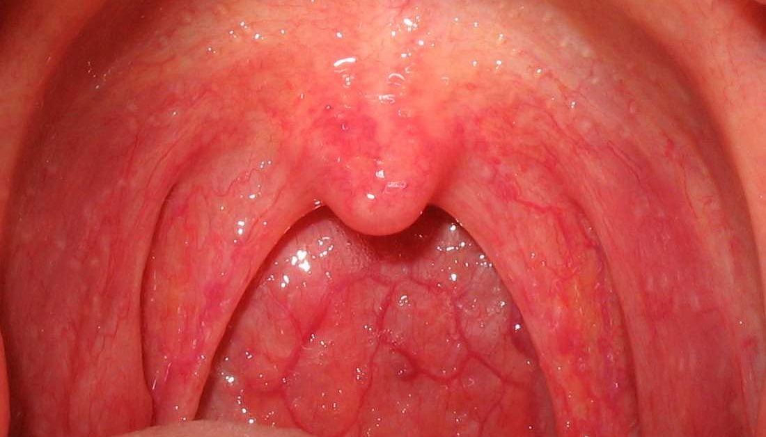 normal throat bumps