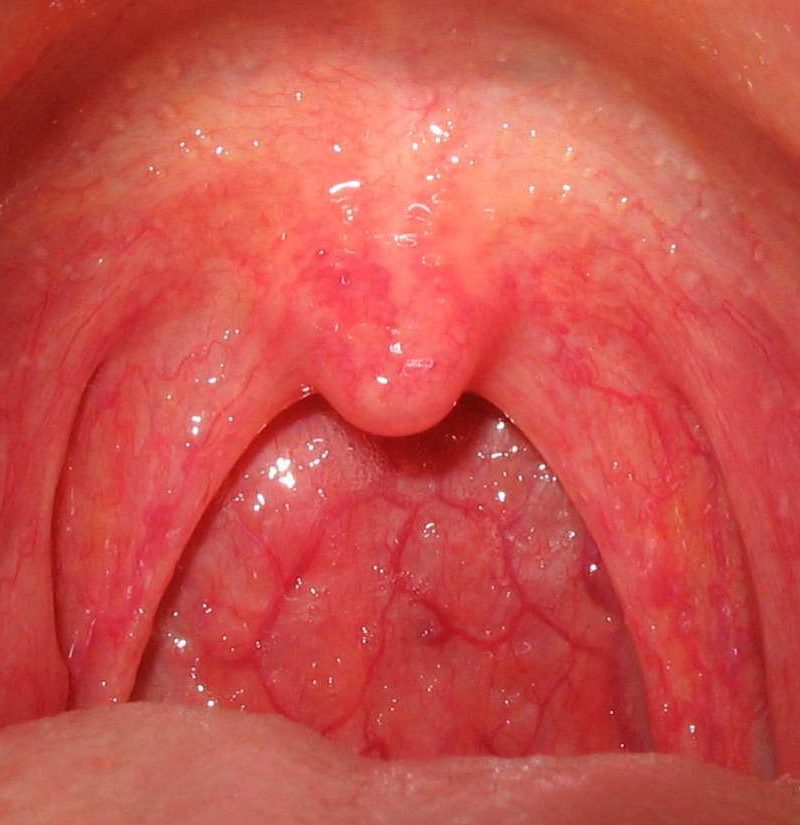 Bumps In Back Of Throat Causes Pictures And Treatment