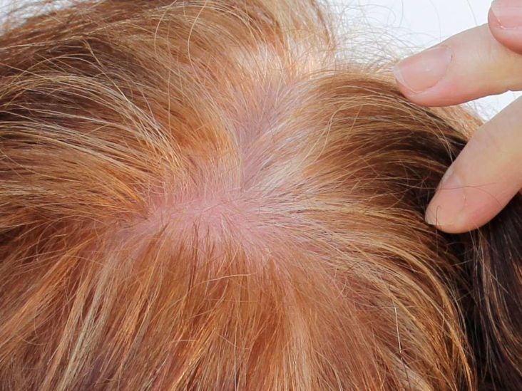 Dermaroller for hair growth: Does it work?