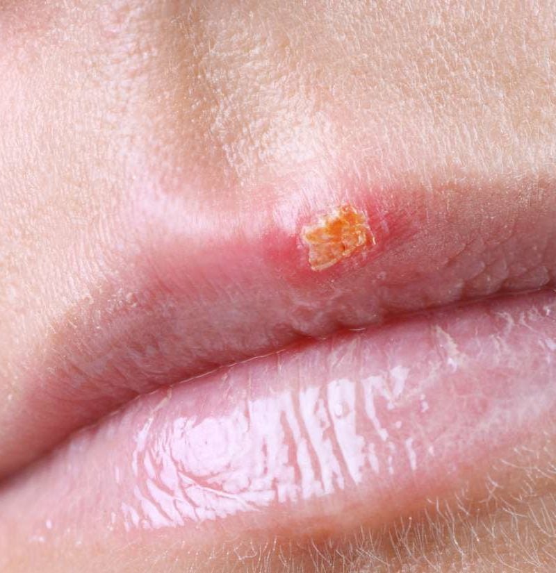 When Does A Cold Sore Stop Being Contagious 