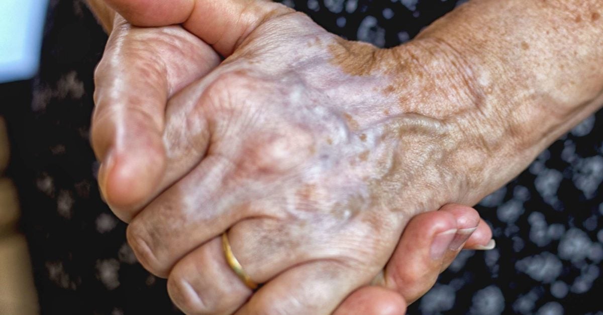 large veins in hands