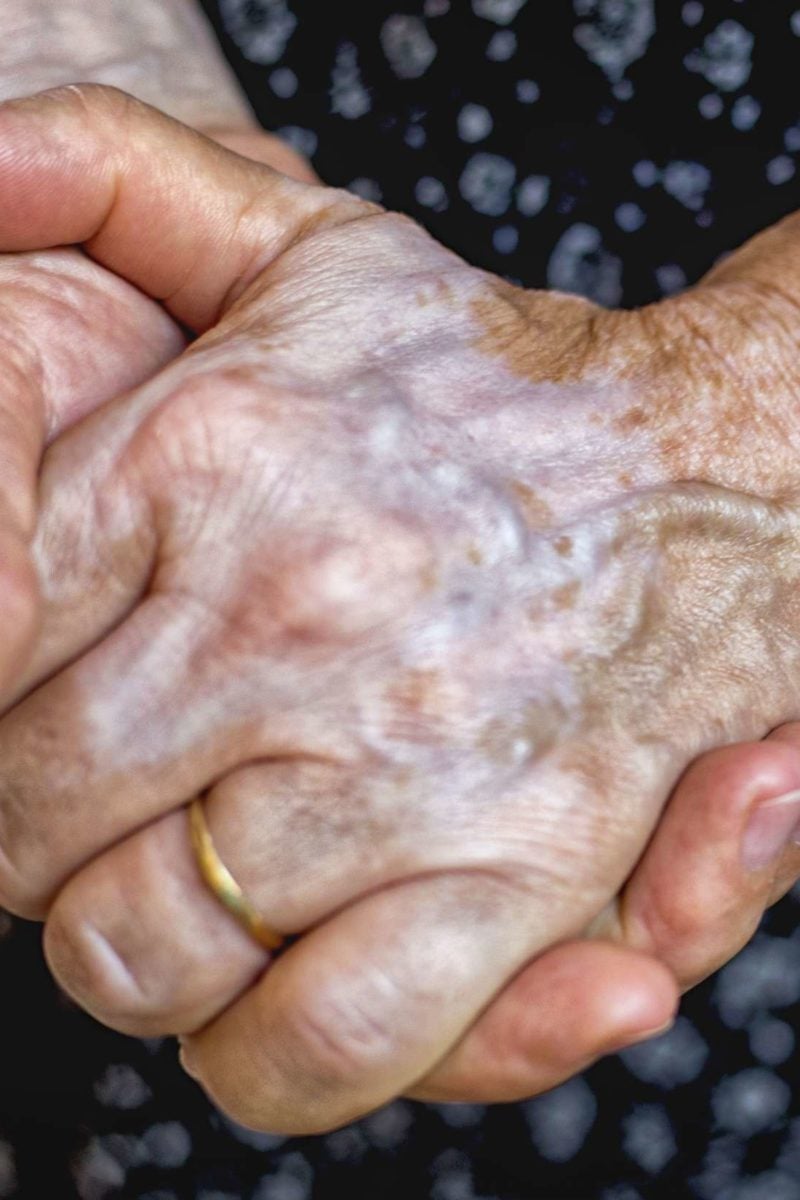 large veins in hands