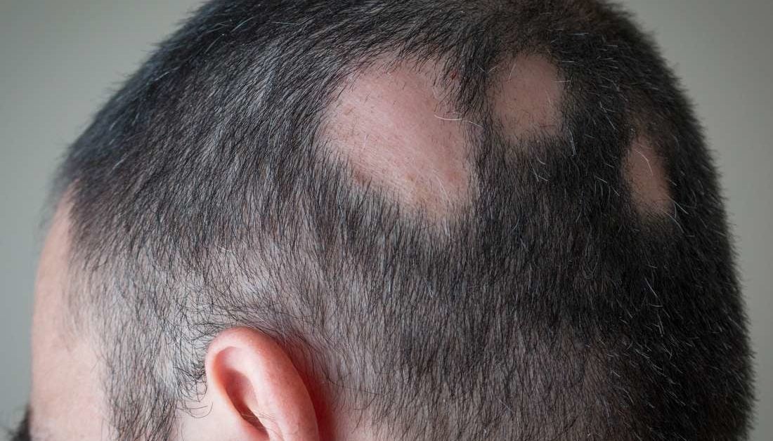 Alopecia areata: Symptoms, treatment, and tips