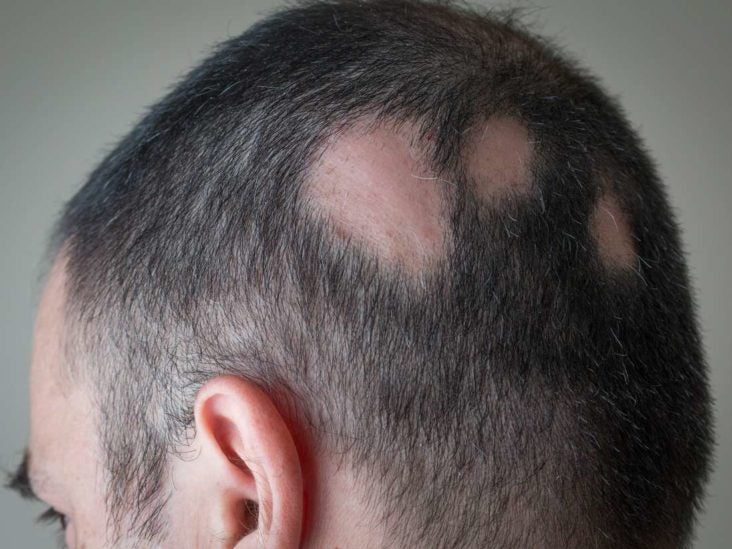 Alopecia areata: Causes, symptoms, and treatment