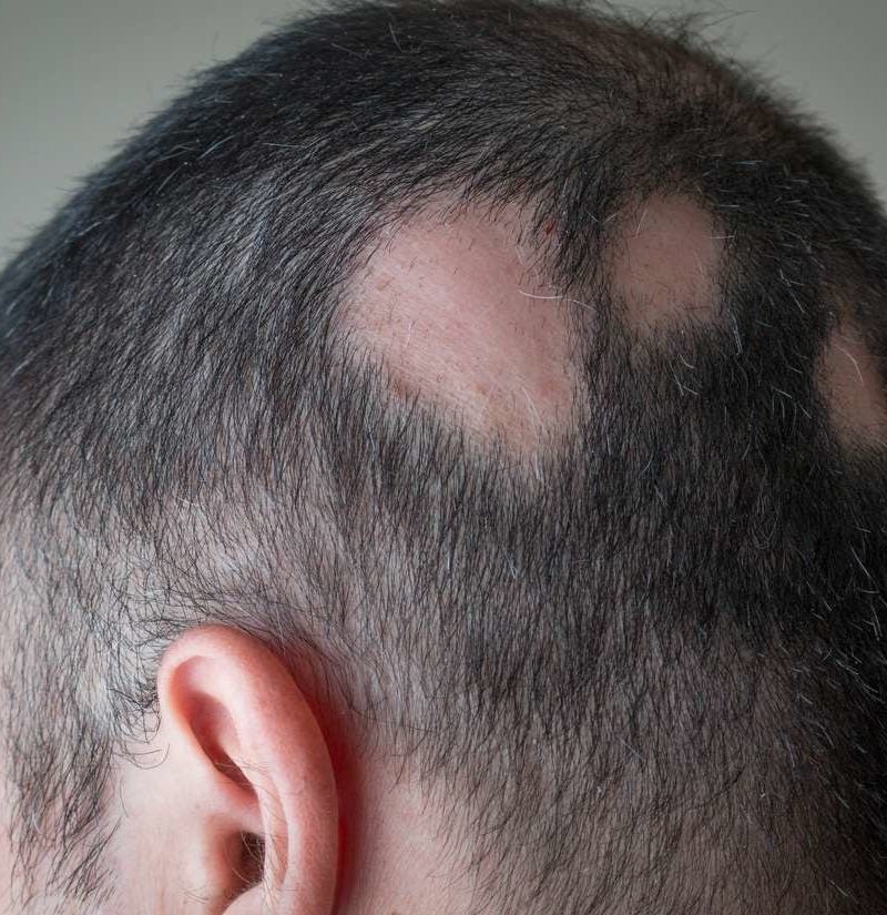 Alopecia areata: Symptoms, treatment, and tips