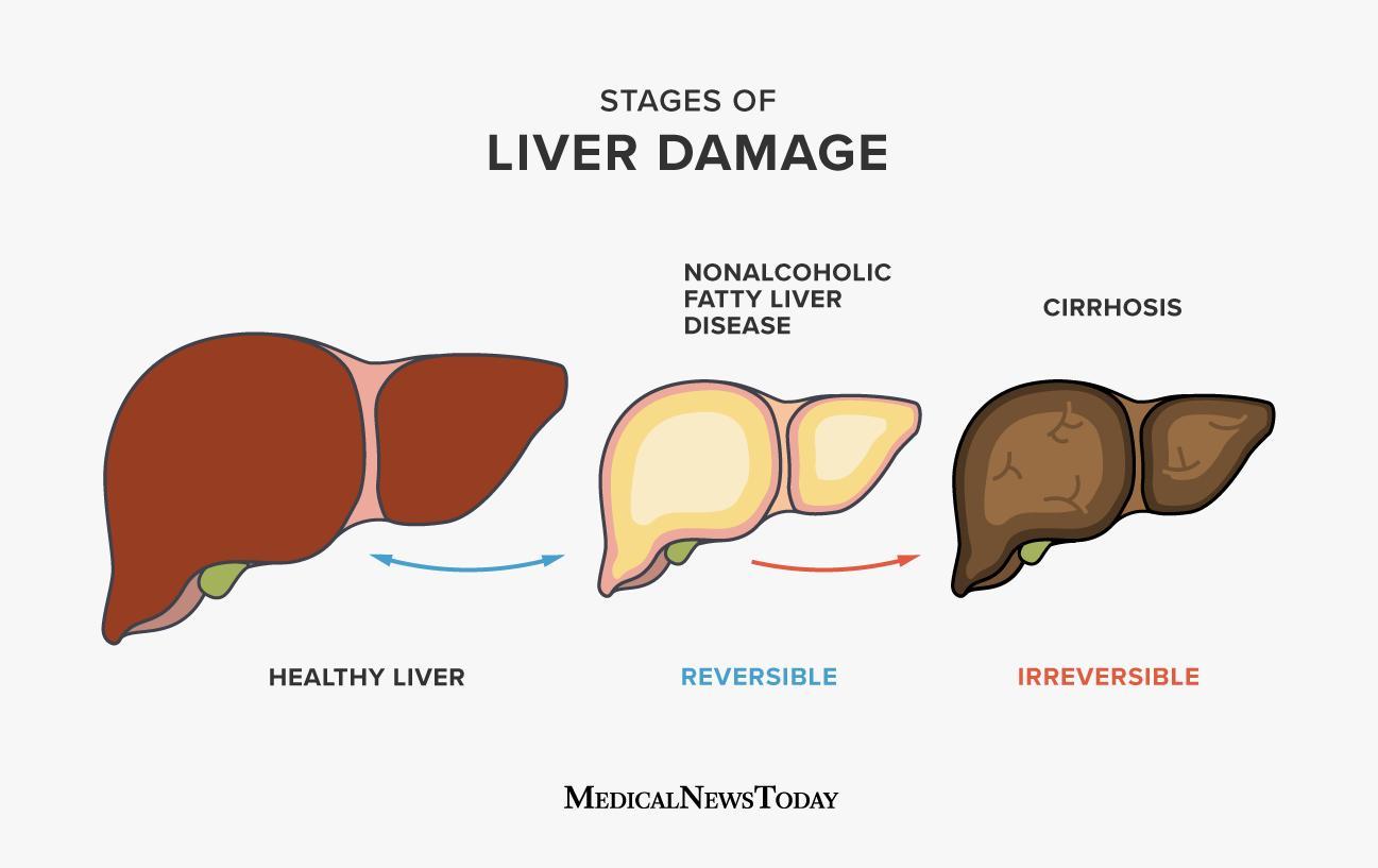 Fatty liver disease Symptoms causes risks and treatment