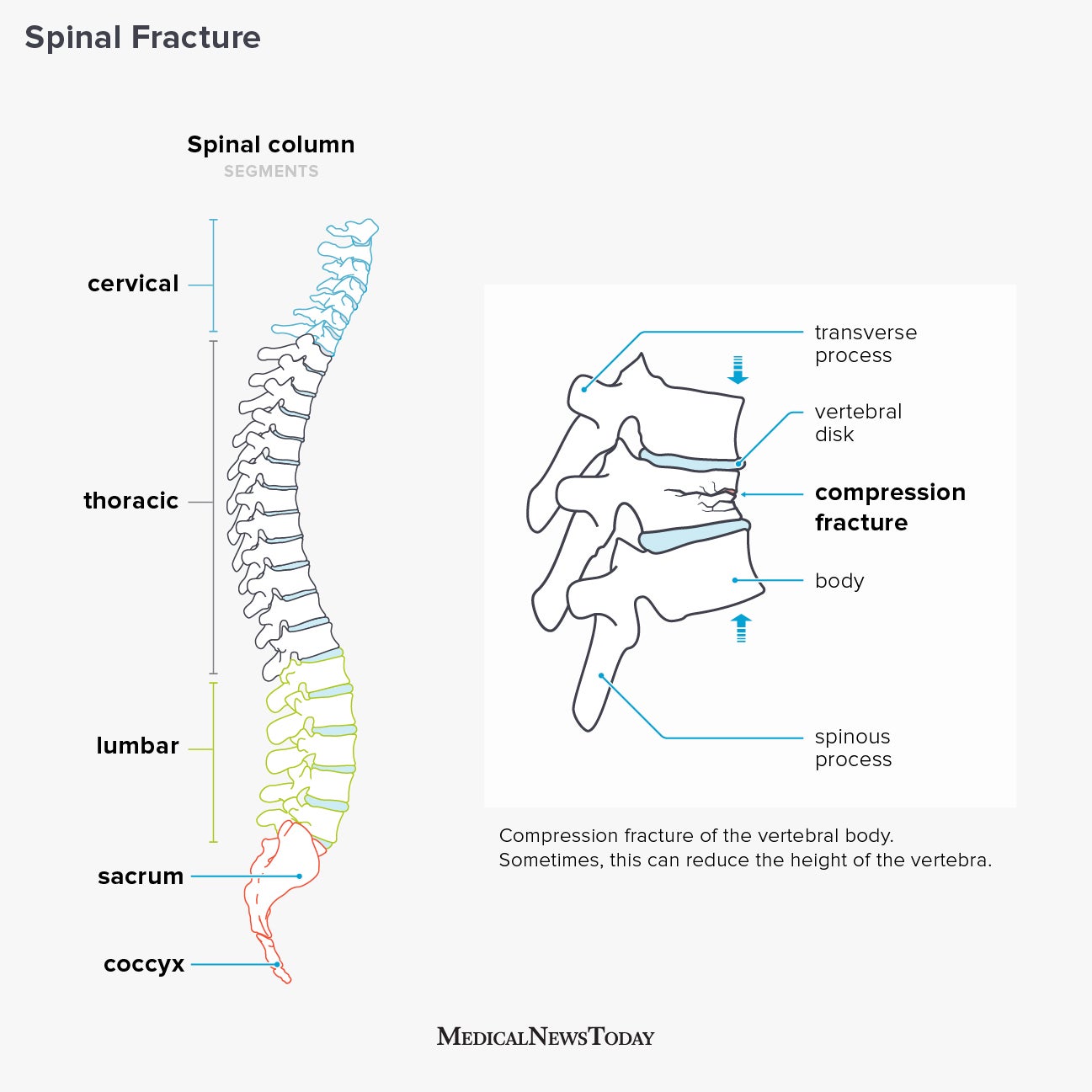 Broken back: Symptoms, treatment, and recovery