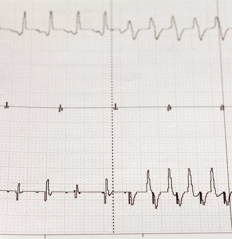 Arrhythmia Causes Symptoms Types And Treatment