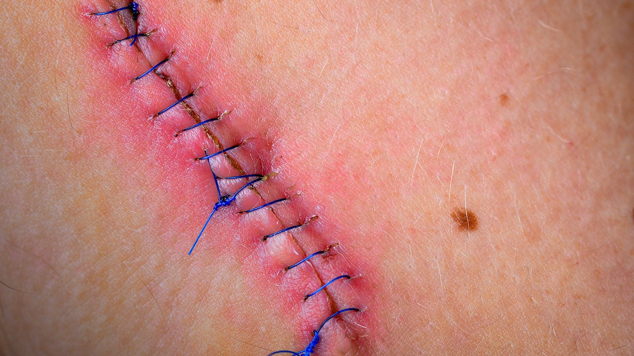 infected cut