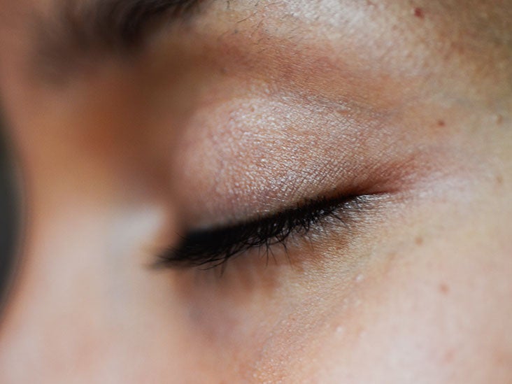 Are Dark Eyelids A Health Warning
