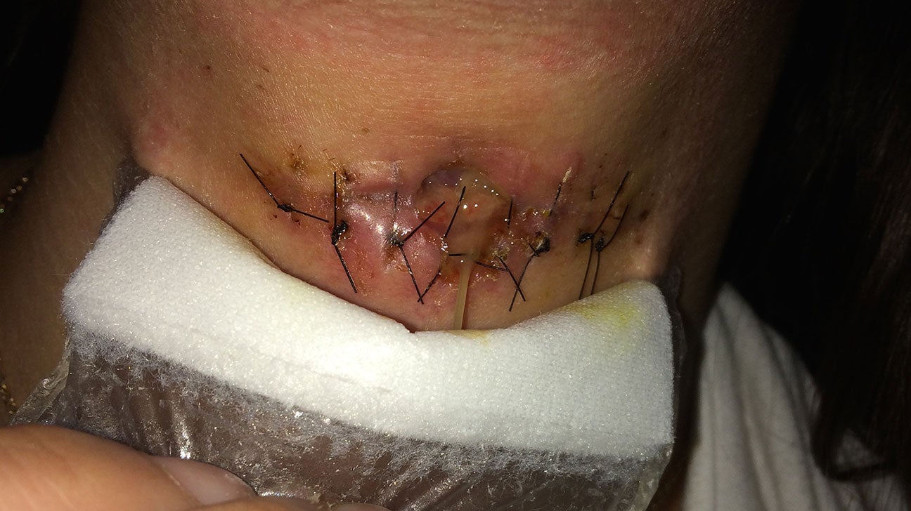 Infected Stitches: Symptoms, Pictures, Risk Factors, Treatment