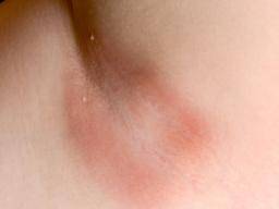 thrush rash