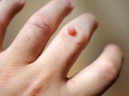 How to remove warts and papilloma - Wart treatment liquid nitrogen blister