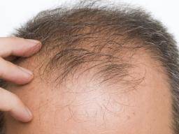 Hair loss most common in summer, fall
