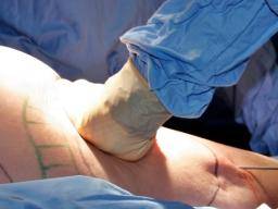 Liposuction: Uses, benefits, and risks