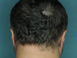 Baldness Cured With Bone Marrow Disease Drug In Alopecia Areata
