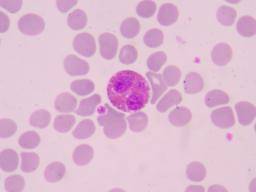 Eosinophils: What are eosinophils and eosinophilia