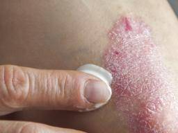 plaque psoriasis ointment)
