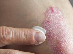 plaque psoriasis treatment cream pikkelysömör kezelés metotrexát