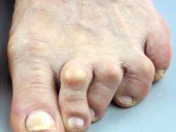 Pain at big toe joint: Causes and relief