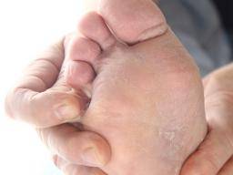 mild toe fungus treatment