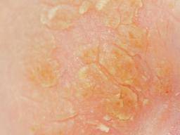 difference between eczema and psoriasis