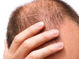 Arthritis drug helps bald man grow full head of hair