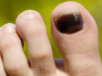 Black Fingernail Discoloration | AAFP
