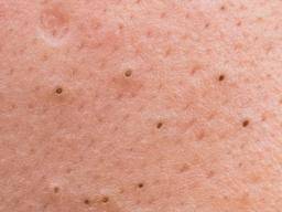 Blackheads Facts Causes And Treatment