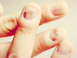 Share 138+ antibiotics for nail bed infection
