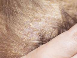 Seborrheic dermatitis hair loss: Causes and treatment