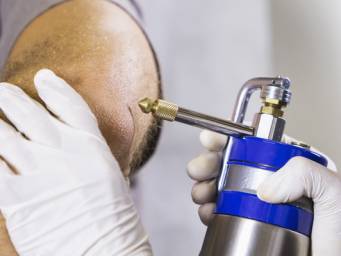 hpv treatment liquid nitrogen