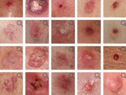 Basal Cell Carcinoma Pictures Early Stages