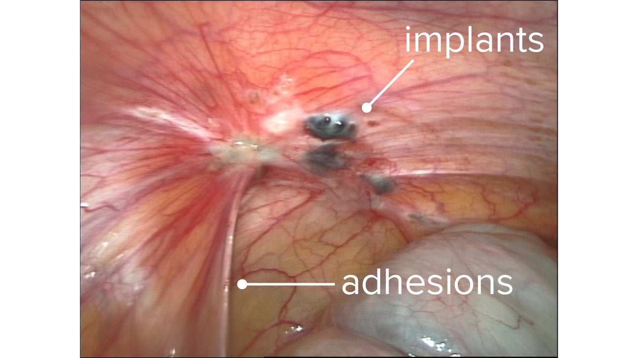 Endometriosis adhesions: Symptoms, formation, and pictures