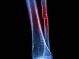 Fibula fracture: Symptoms, treatment, and recovery