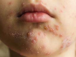 Skin rash: Causes, 68 pictures of symptoms, and treatments