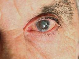 Sporadic eye pain