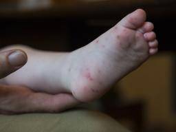 Hand, foot, and mouth disease: Symptoms 