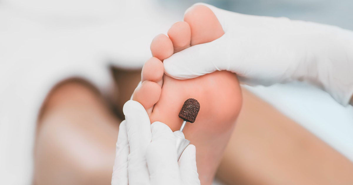 Can A Podiatrist Remove Dead Skin on the Feet