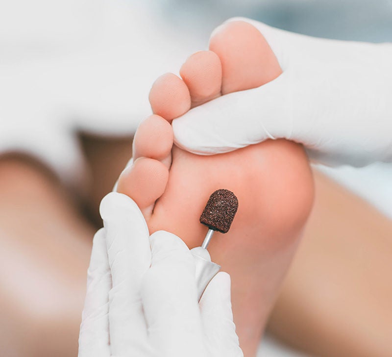 Ingrown Toenails Removal | Oregon Institute of Foot Care