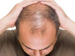 Cure For Baldness Stem Cells Bring Hope