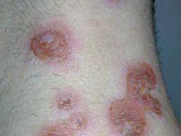 impetigo treatment medicalnewstoday