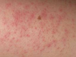 Keratosis Pilaris Causes Symptoms And Treatment