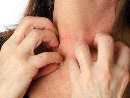 toxic shock syndrome rash on neck