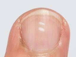 What do vertical lines on fingernails indicate? - Quora