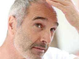 Male Head With Hair Loss Symptoms Front Side Stock Photo Picture And  Royalty Free Image Image 33223801