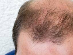 DHT (dihydrotestosterone): What is DHT's role in baldness?