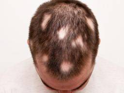 Can Birth Control Cause Hair Loss Risks And Treatments