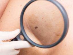 Moles: Types, causes, treatment, and diagnosis